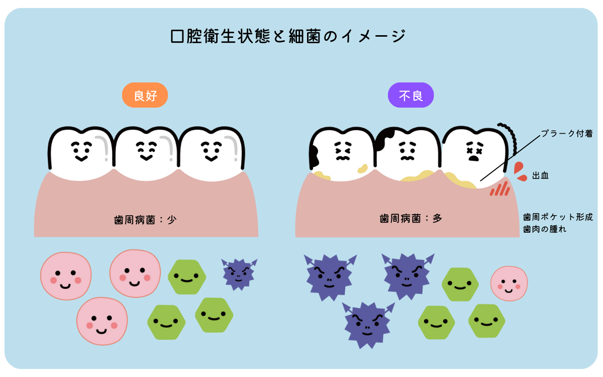 口腔衛生状態と細菌のイメージ図